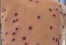 ST1 – Their Acne As Severe (MonkeyPox)